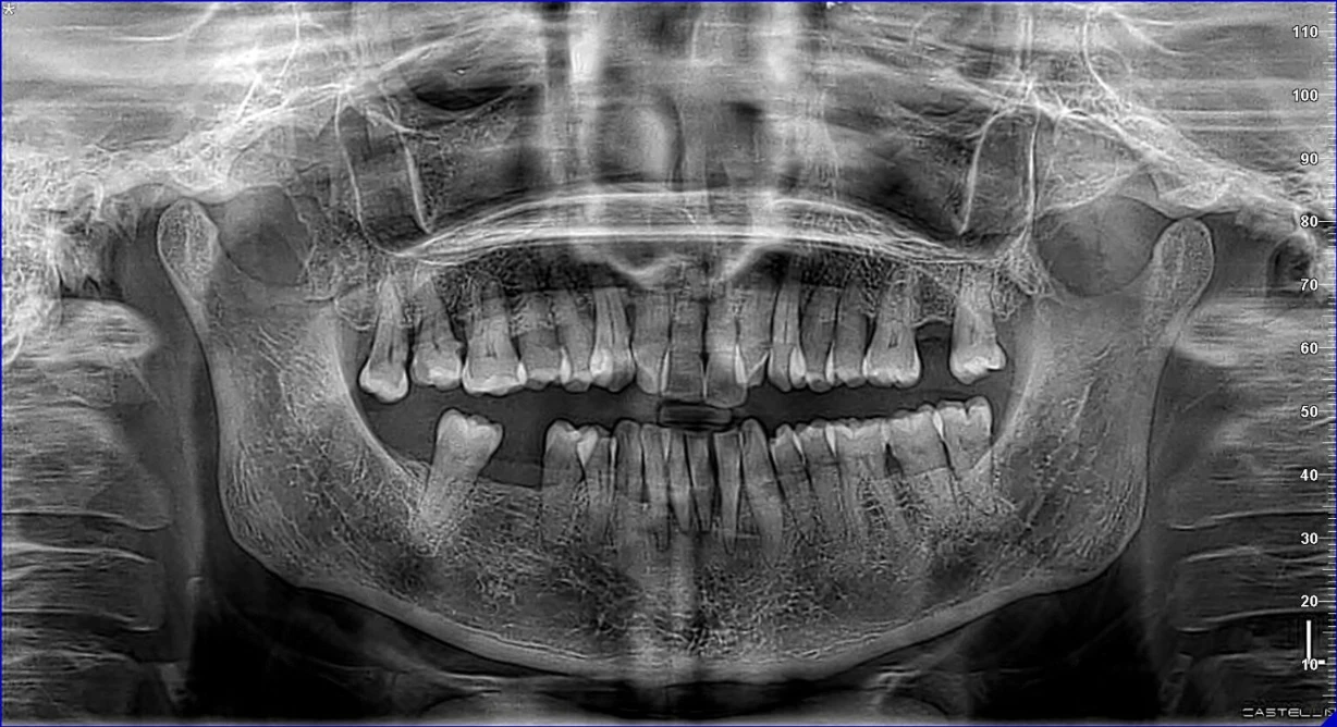 extraction dents de sagesse marrakech radio panoramique 2d dentaire, centre de radiologie